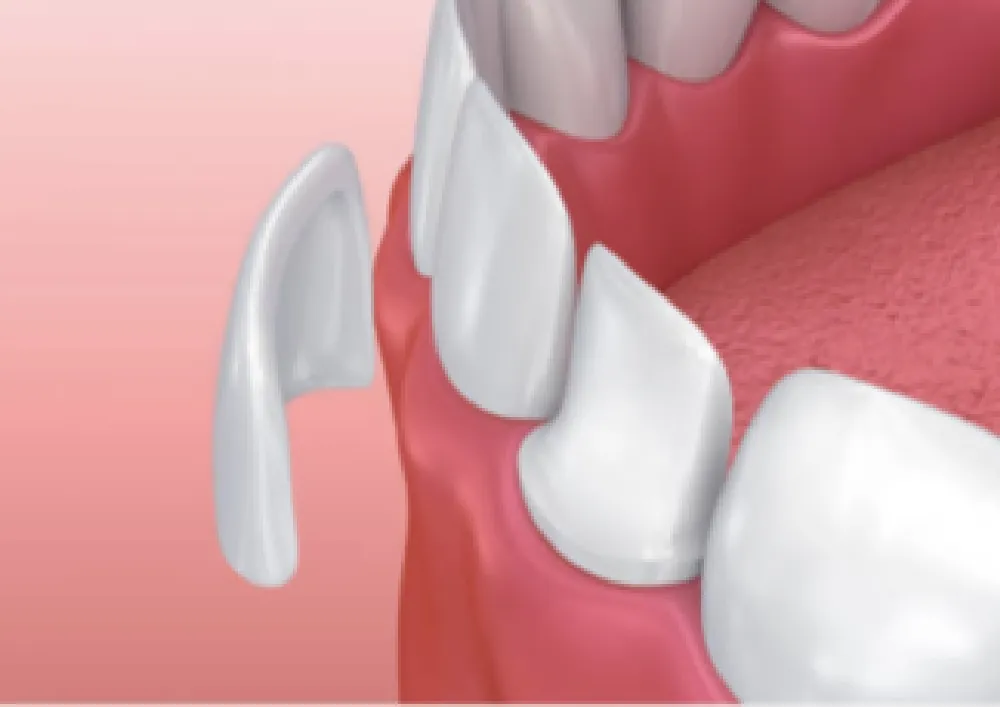 ラミネートべニア