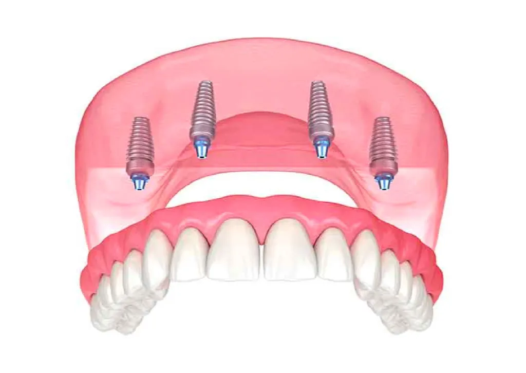 総入れ歯でお悩みの方へ