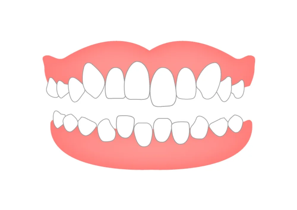 叢生（ガタガタの歯ならび）