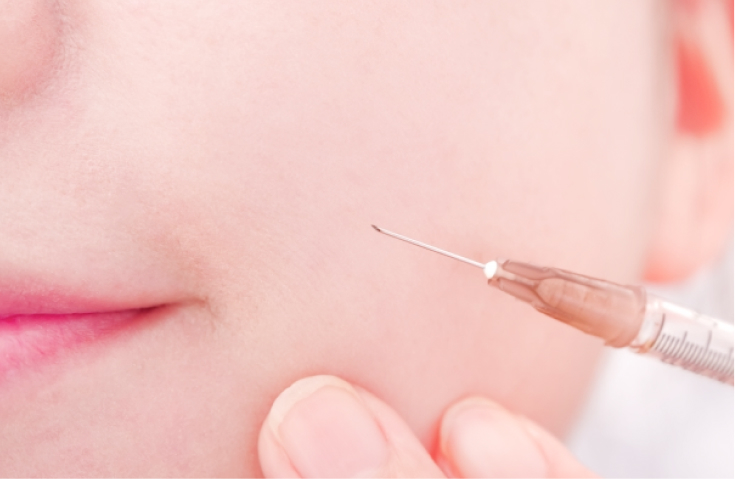 咬筋ボトックス治療