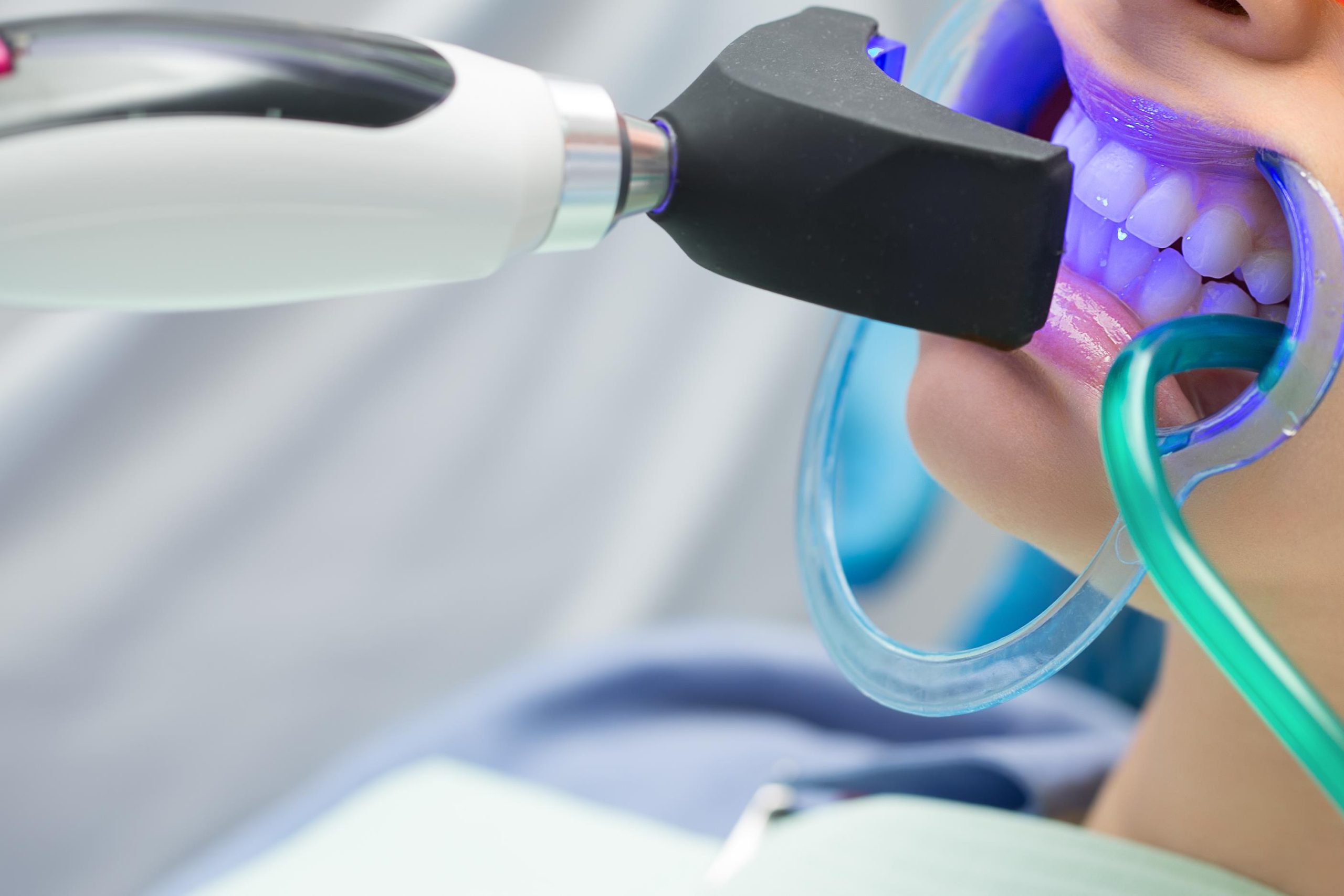 歯科医院でおこなうオフィスホワイトニング